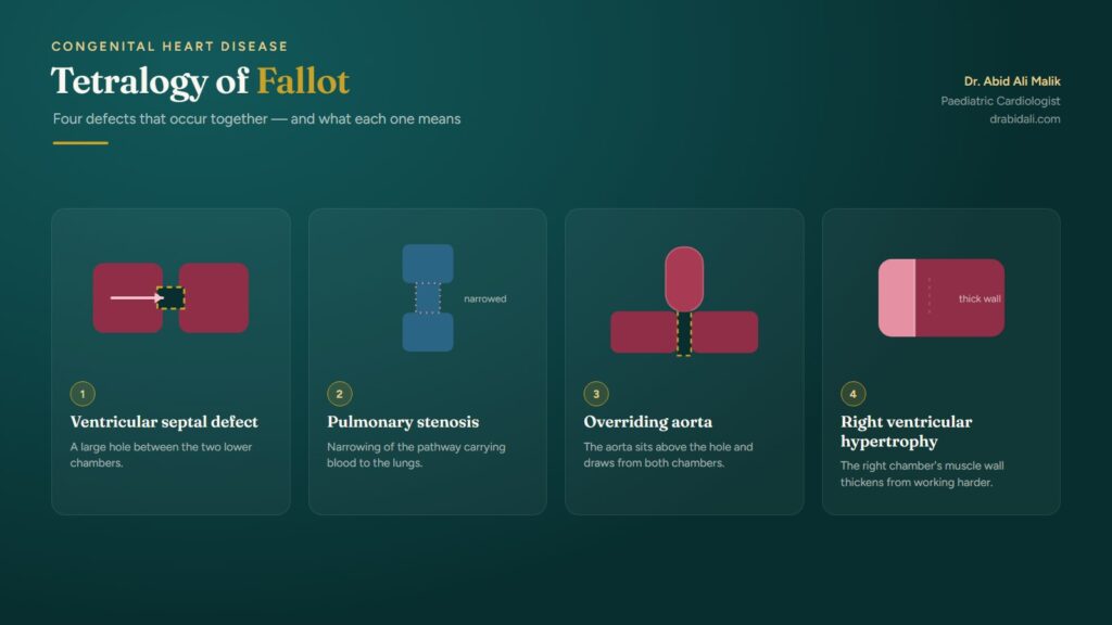 Tetralogy of Fallot (TOF): Understanding the Blue Baby Heart Condition