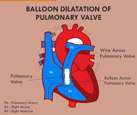 Pulmonary Stenosis in Children: What Parents Need to Know